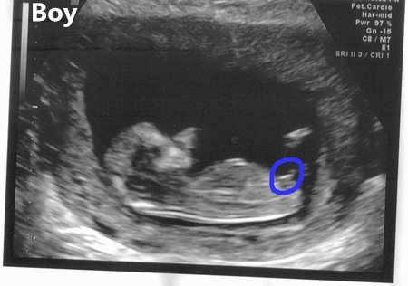 babys sex