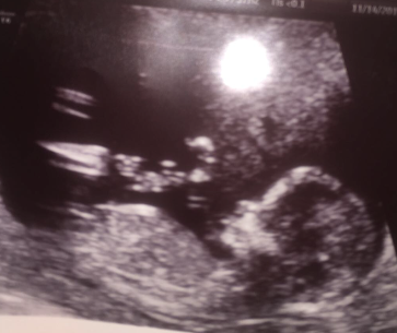 babys sex