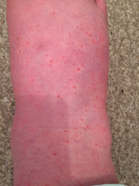 Scabies rash? (Pic)