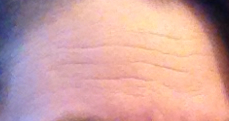 Forehead lines