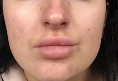 Feel really down about my skin. Pics included