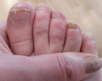 Gel toes with funny toe (Pics)