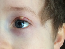 Please look at this cyst on my 5 year old’s eyelid