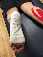 Plantar fasciitis & nerve entrapment