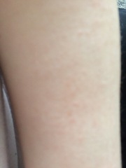 Rash on DS2