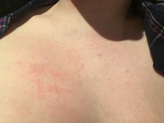 Persistent rash on chest?