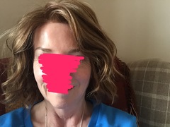 Hair loss support thread