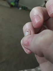 Can I recover damages from a nail salon who ruined my nail permanently?