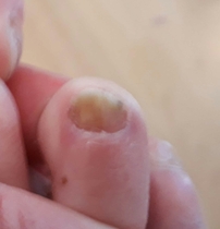 Gel toes with funny toe (Pics)