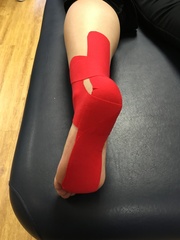 Plantar fasciitis & nerve entrapment