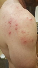 Adult male acne on back and shoulders . Pics included