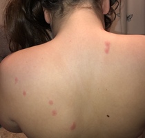 Chickenpox without blisters????