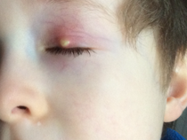Please look at this cyst on my 5 year old’s eyelid
