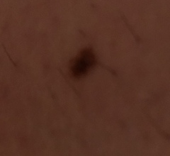 Moles Help - Pic Included