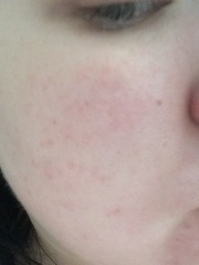 Rash on DS2