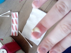 Paronychia? Pic included