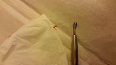 From a teen's ear - pic