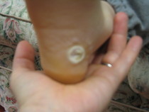 Gross picture sorry- is this a corn or a verrucca?