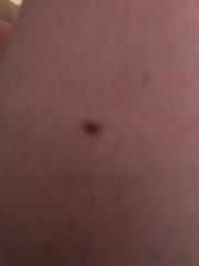 Moles Help - Pic Included