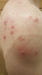 Adult male acne on back and shoulders . Pics included