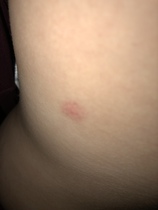 Chickenpox without blisters????