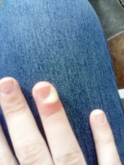 Paronychia? Pic included