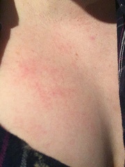Persistent rash on chest?
