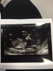 12 week scan,tilted womb,baby SAT UP!