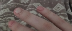 Can I recover damages from a nail salon who ruined my nail permanently?