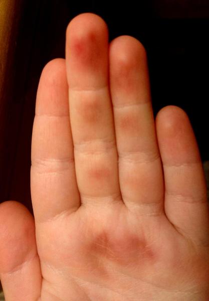 What is coal treated with? Weird skin reaction.