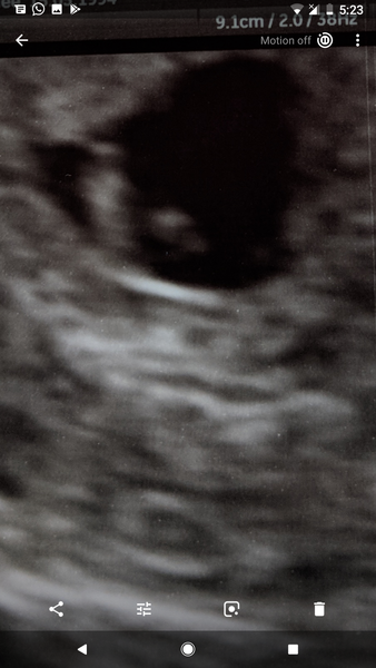 Could I be having twins ?!
