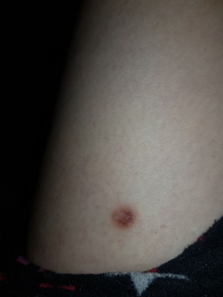 Sore mole going to make GP appt after easter