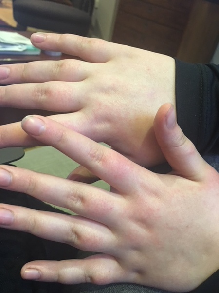 Swollen fingers - pic