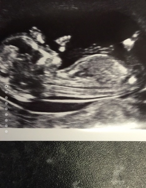 Boy or Girl?
