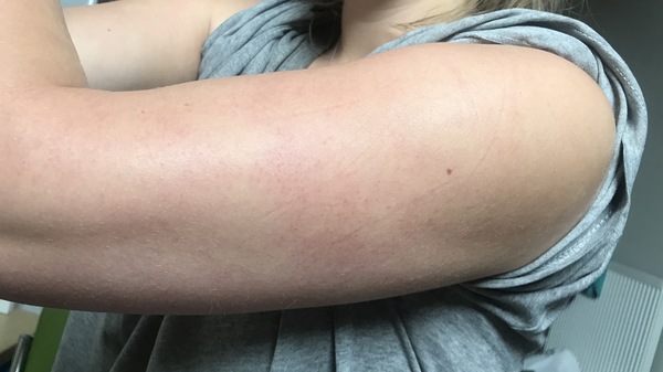 Keratosis pilaris- has anything worked 100% for you? Thinking about chemical peel
