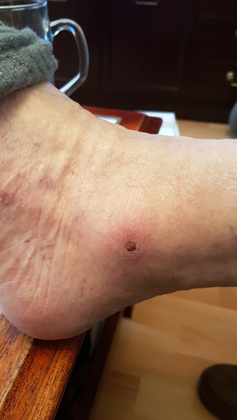 Any ideas on this sore on my dad's leg?