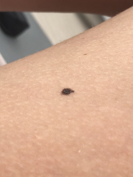 Mole got worries me