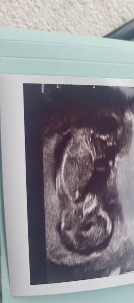 13 weeks scan pics-  anyone fancy a guess at the sex?