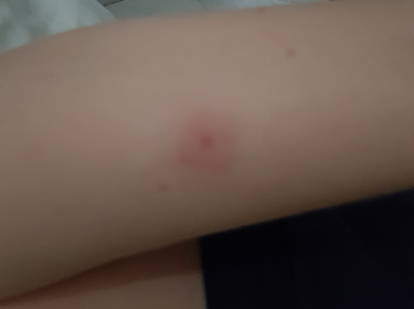 What has bitten me? Pics...