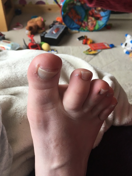 Does a falling-off toenail count as sporn?