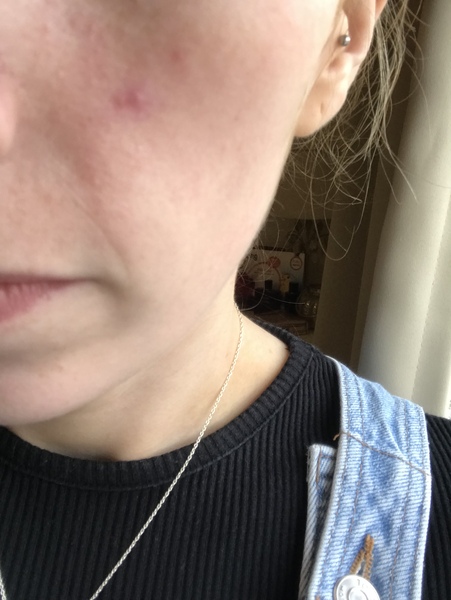 Spot on my face isn’t healing. Been there since January!
