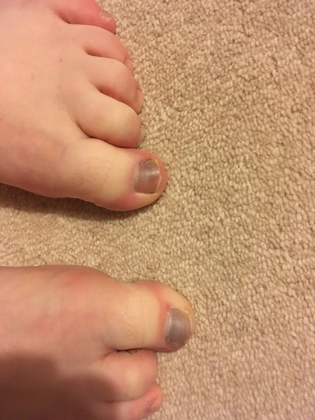 Does a falling-off toenail count as sporn?