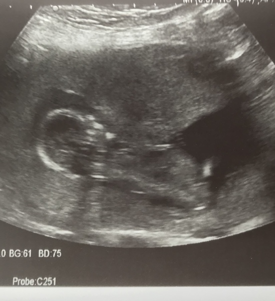 Ultrasound tech says it’s a boy 15 weeks