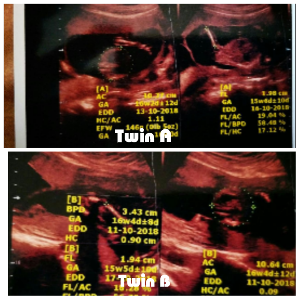 Nub theory guesses for twins