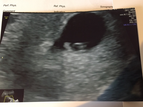 Early scan this morning-so nervous!