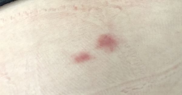 Does this look like shingles?