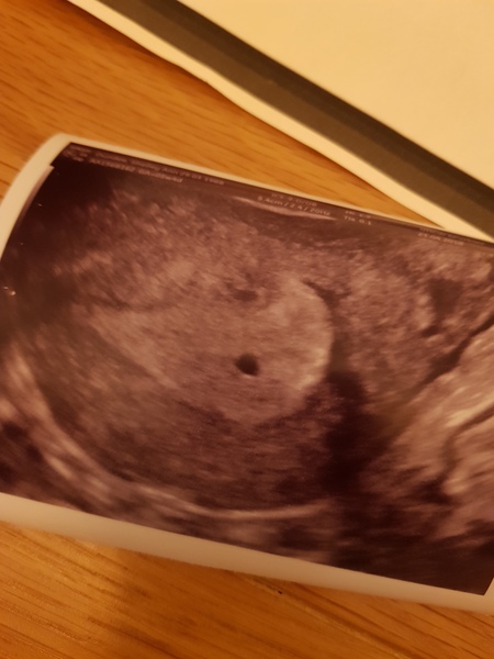 Reassure me please 5 weeks preggers (post mc)
