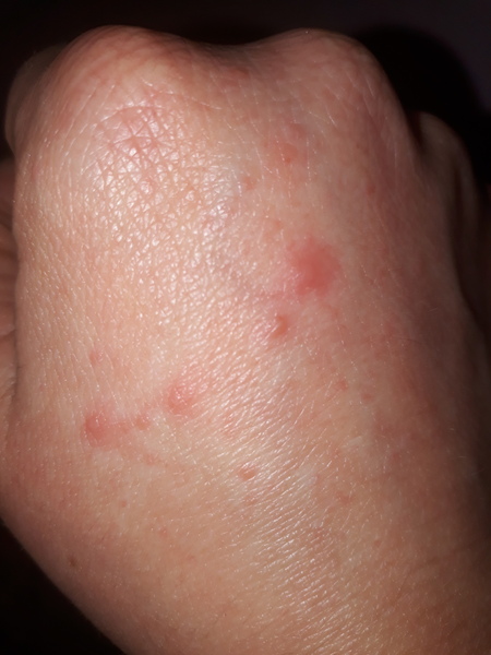 Anyone know what these blisters are on my hands?