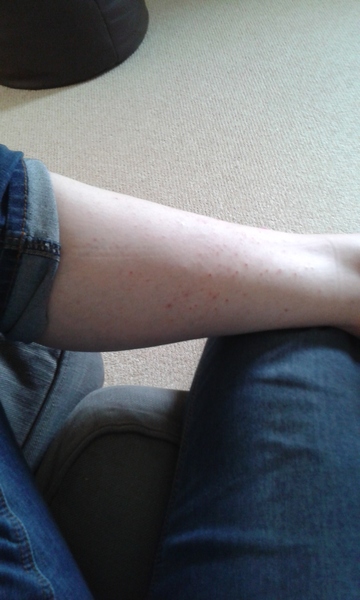 Ingrown hairs? :( :(