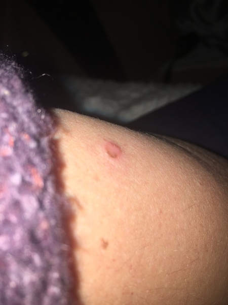 Sore mole going to make GP appt after easter